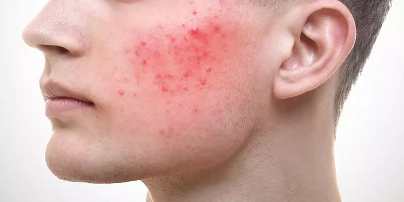 Rosacea treatment