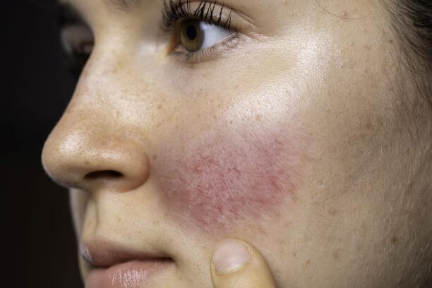 Rosacea treatment